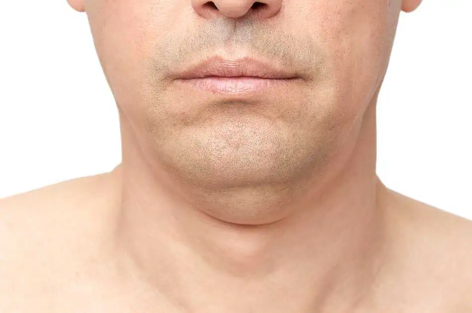 Kybella Injections In Addison, TX by Star Rejuvenation & Wellness