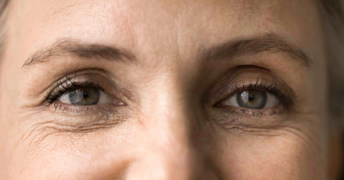 Close-up of mature woman’s eyes showing fine lines and wrinkles around the eye area, treated with CoolPeel® CO2 Laser in Addison, TX.