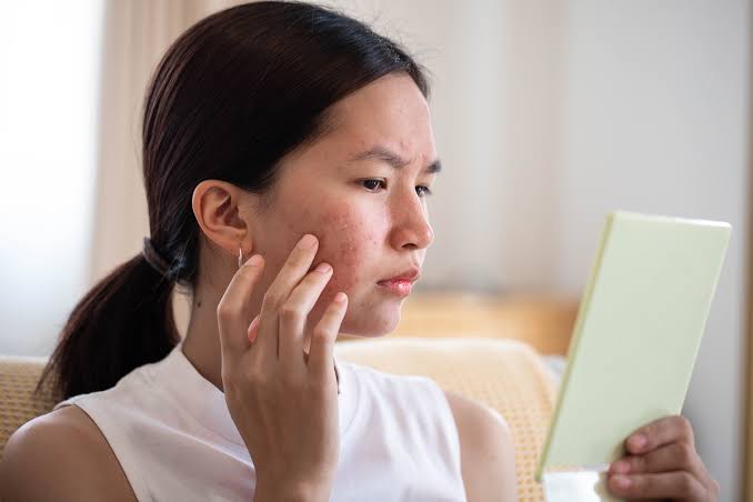 girl looking in mirror at acne scars