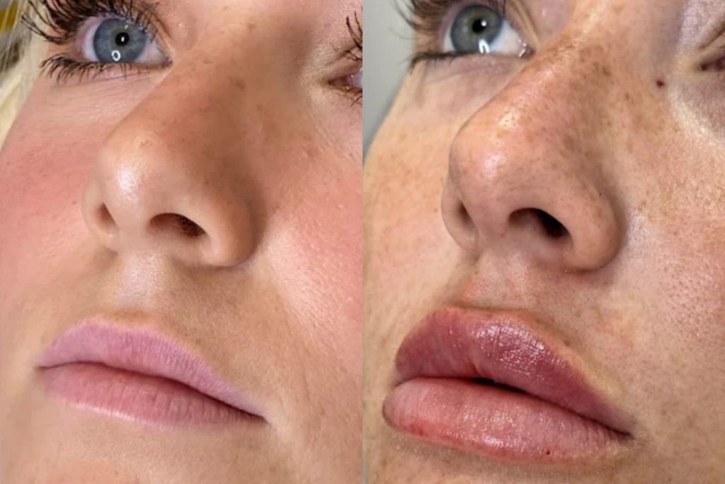 lip filler before after