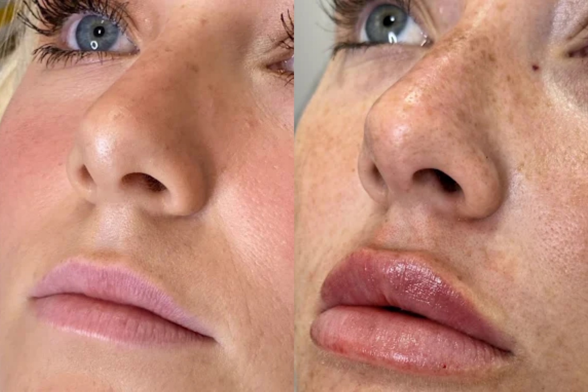 lip filler before after