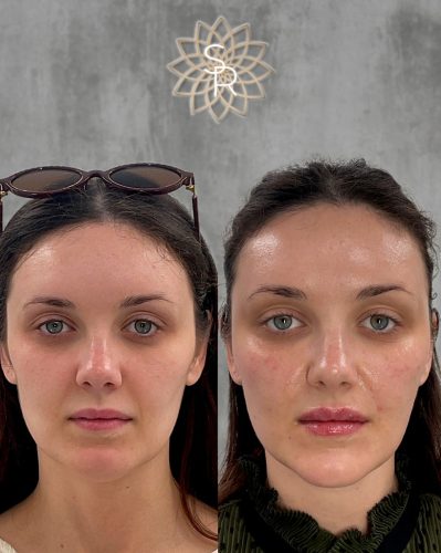 Facial Balancing Before and After 1