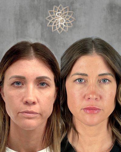 Facial Balancing Before and After 2
