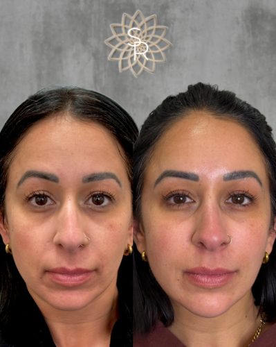 Facial Balancing Before and After 3