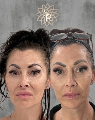 Facial Balancing Before and After 4