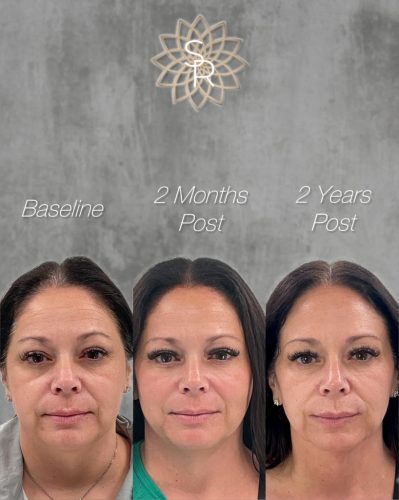 Facial Balancing Before and After 5
